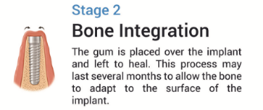 Implant satge 2-585-840-227